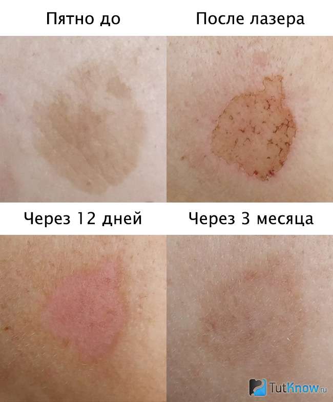 Пигментное пятно на щеке - после лазера появилось снова