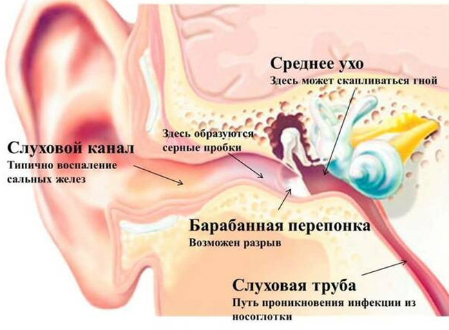 Ошибки в использовании ушных палочек